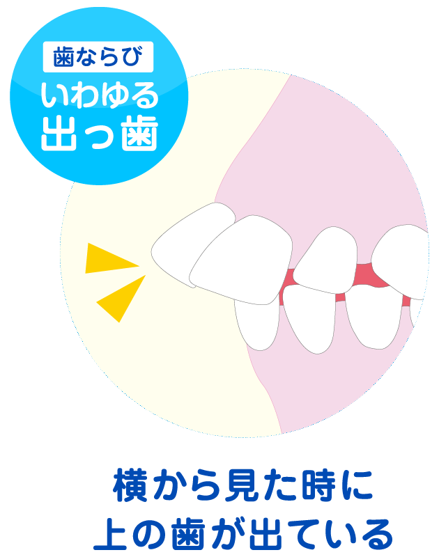 いわゆる出っ歯