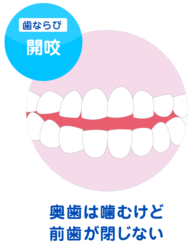 開咬