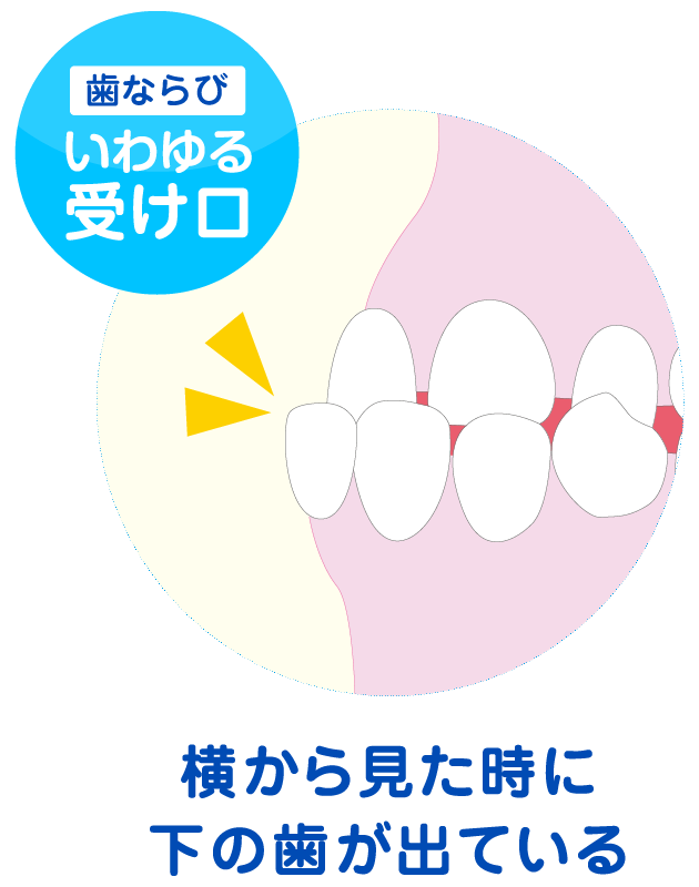 いわゆる受け口
